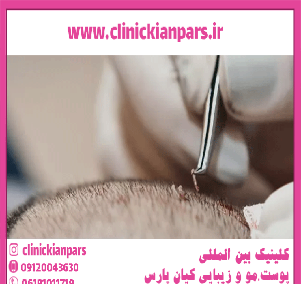 عکس عفونت سر بعد از کاشت مو