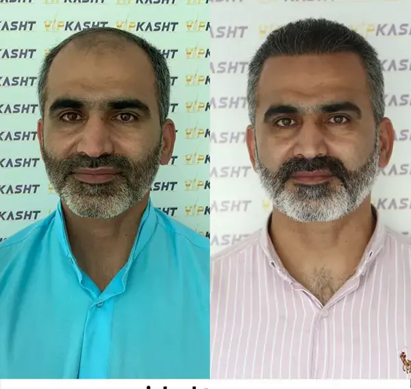 عکس اتاق عمل کاشت مو