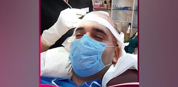 عکس اتاق عمل کاشت مو