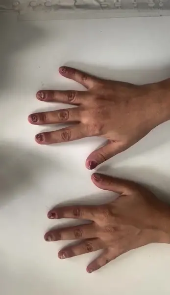 عکس قارچ ناخن کاشت شده