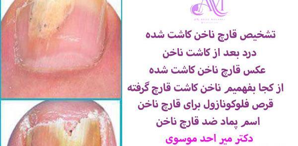 عکس قارچ ناخن کاشت شده