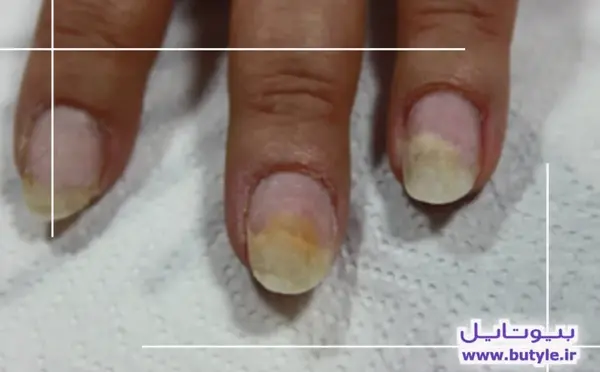 عکس قارچ ناخن کاشت شده