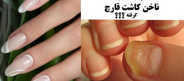 عکس قارچ ناخن کاشت شده