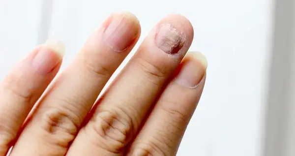 عکس قارچ ناخن کاشت شده