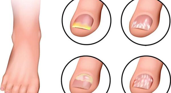 عکس قارچ ناخن کاشت شده