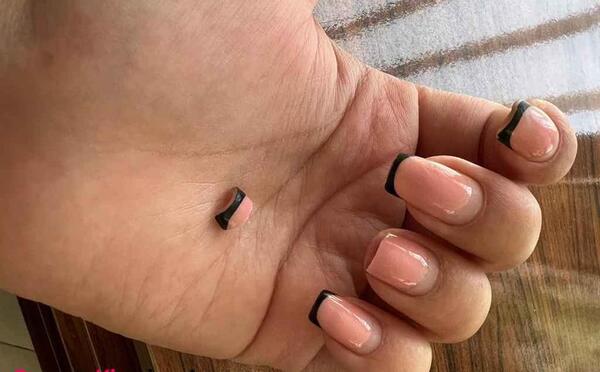 عکس کاشت ژلیکس