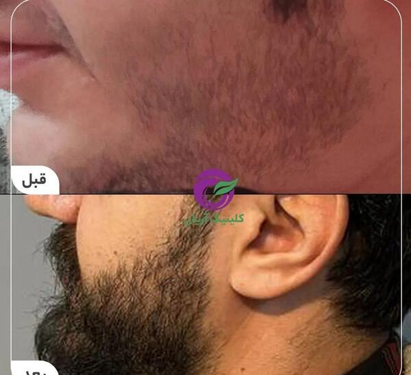 عکس های کاشت ریش