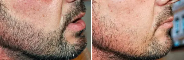 عکس های کاشت ریش