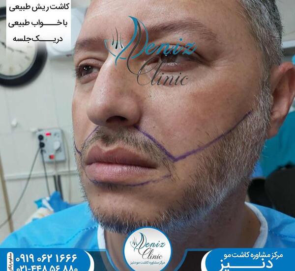 عکس های کاشت ریش