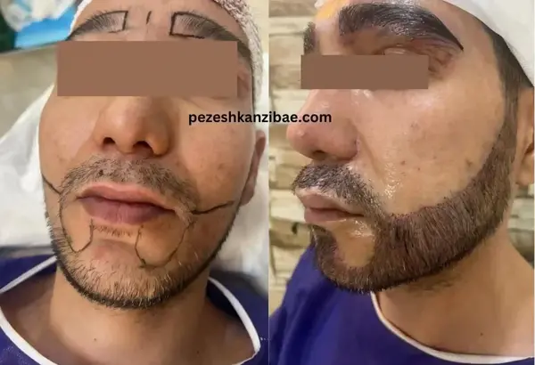 عکس های کاشت ریش
