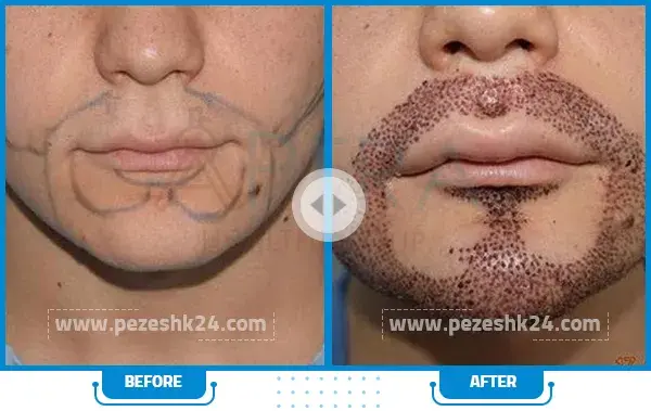 عکس های کاشت ریش