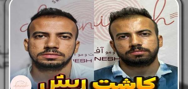 عکس های کاشت ریش