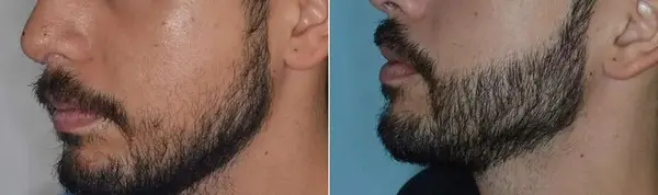 عکس های کاشت ریش