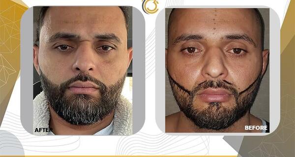 عکس قبل و بعد کاشت ریش