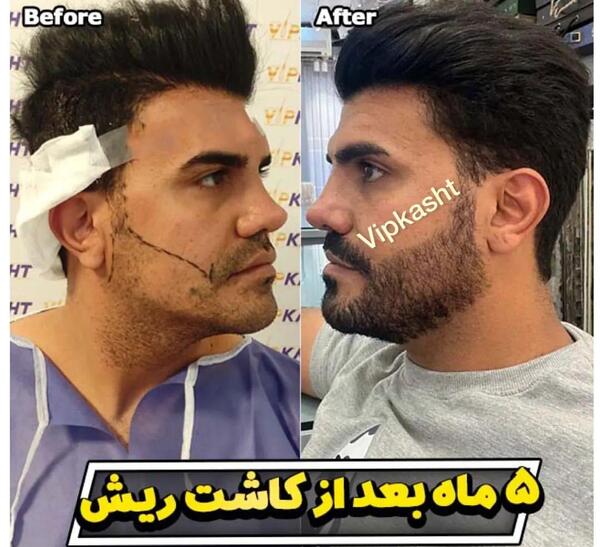 عکس قبل و بعد کاشت ریش