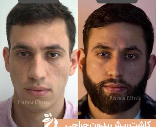 عکس قبل و بعد کاشت ریش