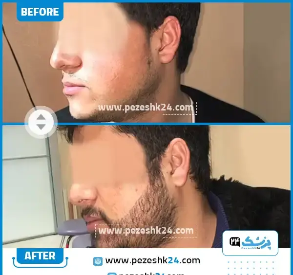 عکس قبل و بعد کاشت ریش