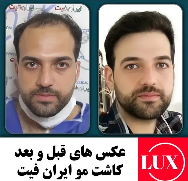 عکس قبل و بعد کاشت ریش