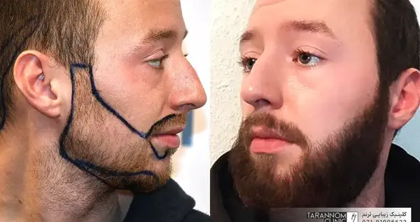 عکس قبل و بعد کاشت ریش