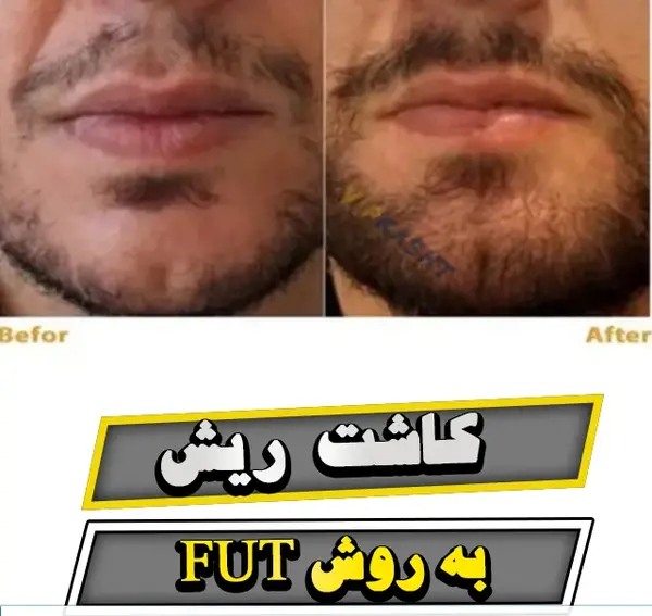 عکس قبل و بعد کاشت ریش