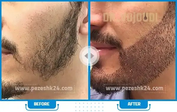 عکس قبل و بعد کاشت ریش