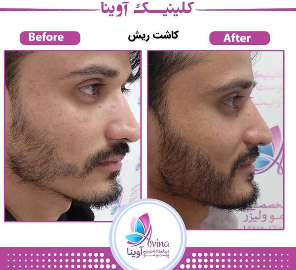 عکس قبل و بعد کاشت ریش