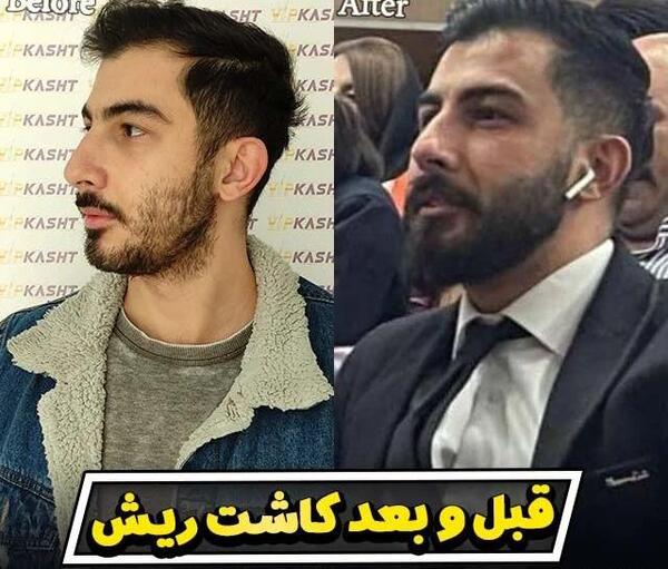 عکس قبل و بعد کاشت ریش