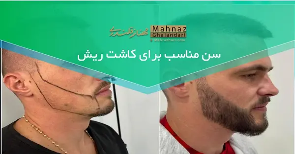عکس قبل و بعد کاشت ریش