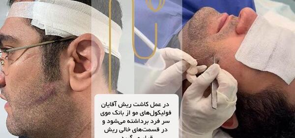عکس قبل و بعد کاشت ریش