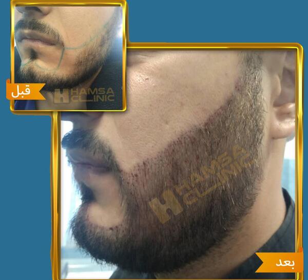 عکس قبل و بعد کاشت ریش