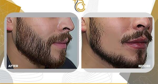 عکس قبل و بعد کاشت ریش