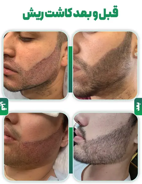 عکس قبل و بعد کاشت ریش