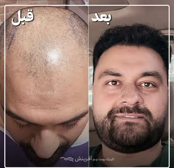 عکس قبل و بعد کاشت ریش
