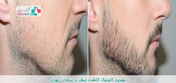 عکس قبل و بعد کاشت ریش