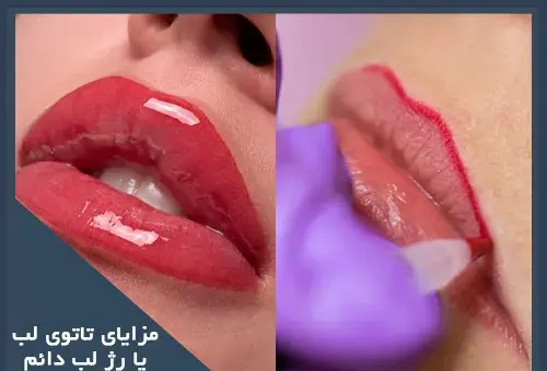 عکس کاشت رژلب دائم