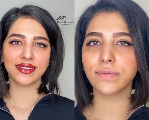 عکس کاشت رژلب دائم