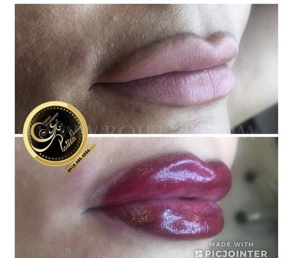 عکس کاشت رژلب دائم