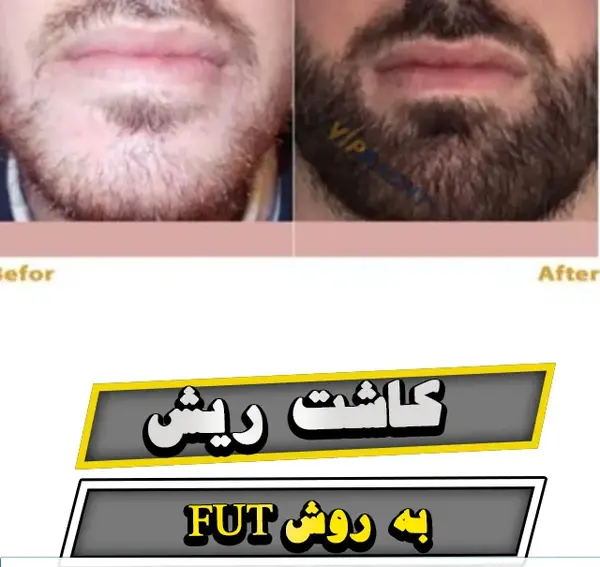عکس قبل و بعد کاشت ریش و سبیل