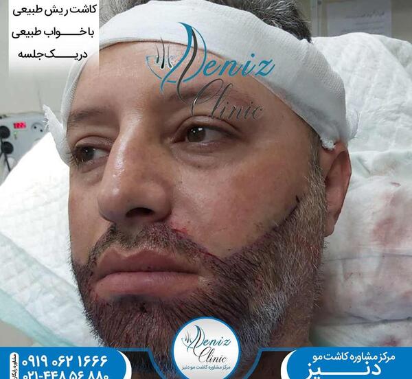 عکس قبل و بعد کاشت ریش و سبیل