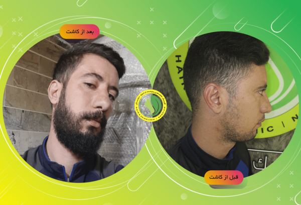 عکس قبل و بعد کاشت ریش و سبیل