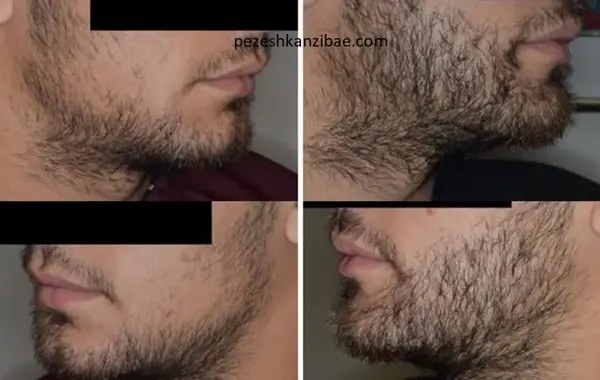عکس قبل و بعد کاشت ریش و سبیل