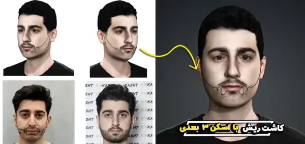 عکس قبل و بعد کاشت ریش و سبیل