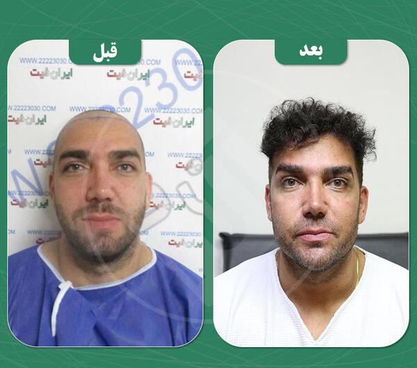 عکس قبل و بعد کاشت ریش و سبیل