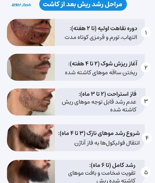عکس قبل و بعد کاشت ریش و سبیل