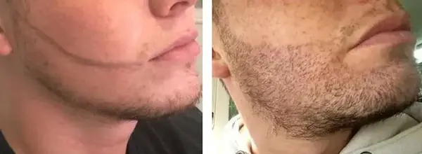 عکس قبل و بعد کاشت ریش و سبیل