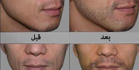 عکس قبل و بعد کاشت ریش و سبیل