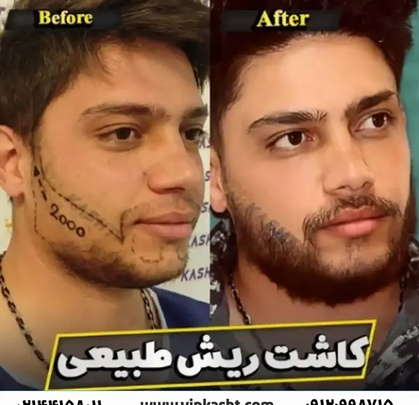 عکس قبل و بعد کاشت ریش و سبیل