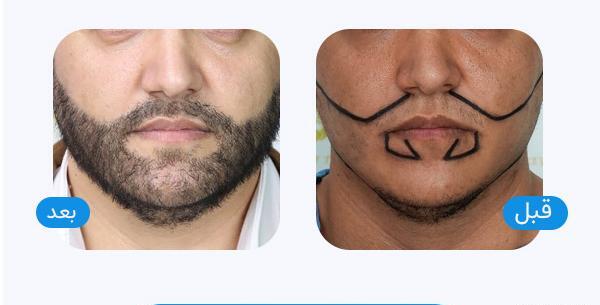 عکس قبل و بعد کاشت ریش و سبیل