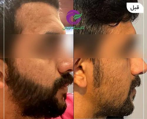 عکس قبل و بعد کاشت ریش و سبیل