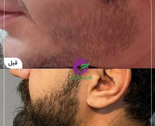 عکس قبل و بعد کاشت ریش و سبیل